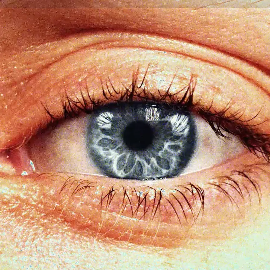 Looksmaxxers are using this risky surgery to change their eye colour